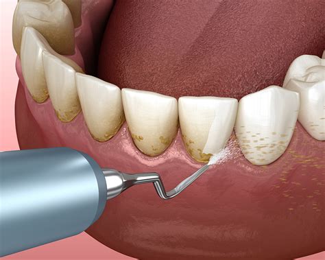 periodontal near me|Gum (Periodontal) Disease Treatment .